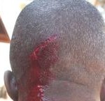 malawi-amos-gumulira_wounded_560x400-AI
