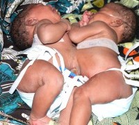 Thyolo Siamese babies die