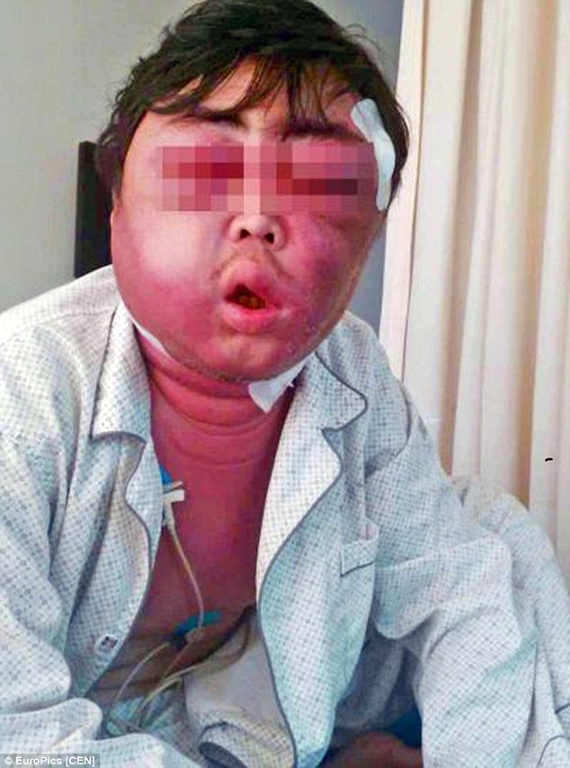 Man head swell into size of a BALLOON after mosquito bite