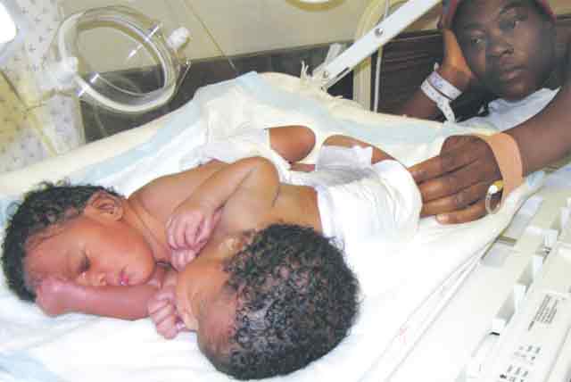 Conjoined twins to undergo surgery on Wednesday