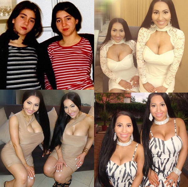Twins Who Spent $250k On Plastic Surgery To Look Exactly The Same, Says They Regret It All, After Suffering Body Dysmorphia