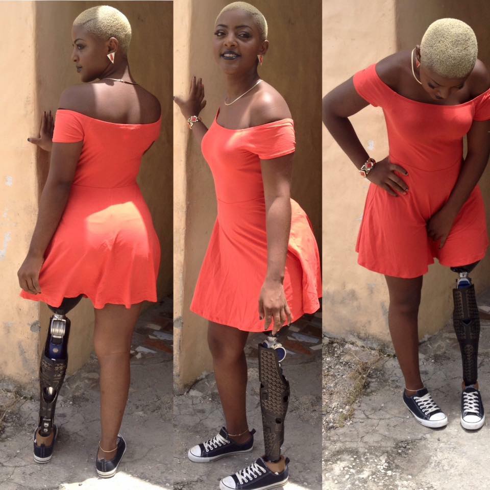 Meet This Pretty 23-Year-Old Girl And Cancer Survivor With A Bionic Leg (Photos)