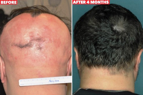 Scientists Have ‘Found a Cure For Baldness’ As Drug Developed to Restore Hair Growth