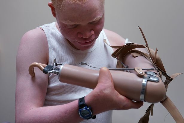 Albino Boy Gets New Body Parts After Witch Doctors Trying to Use Him for Money Rituals Chopped Off His Limb (Photo)