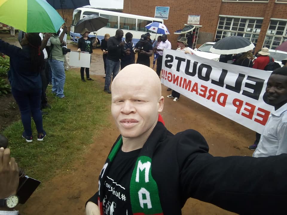 APAM Threatens to Name Perpetrators in Albino Killing Inquiry