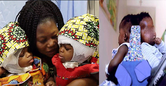 Twins conjoined at the head separated successfully in first-of-its-kind surgery