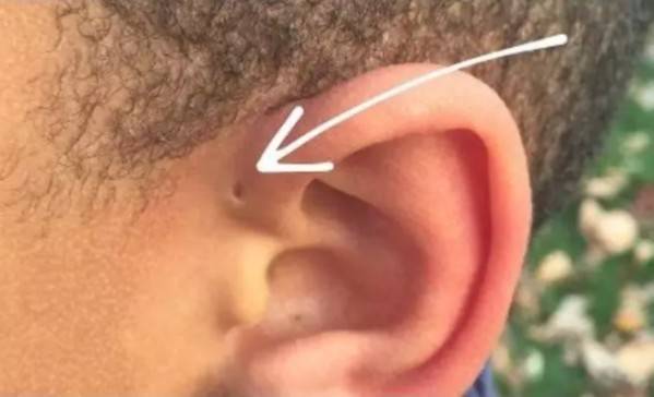 Congratulate Yourself if You Have a “Tiny Hole” Above your Ear, See What it Means.