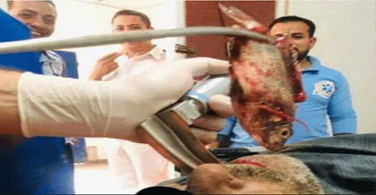 Doctors remove live fish from fisherman’s throat
