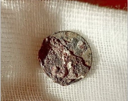 Kid Shoves Metal Coin Into His Nose, Forgets About It For 53 Years