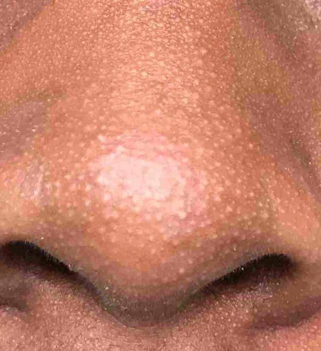 If A Lady Has These Things On Her Nose, This Is What It Means