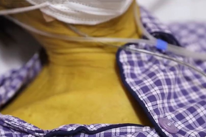 Man’s Skin Turns Bright Yellow After Over 30 Years Of Drinking And Smoking [Photos]