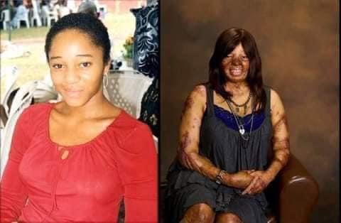PLANE CRASH SURVIVOR EMBRACES HER SCARS (SEE PHOTOS)