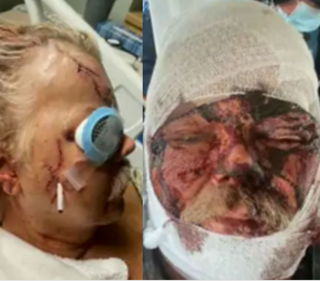 Hiker Survives Gruesome Injuries After Bear Bites Head And Totally Crushes His Jaw [Photos]