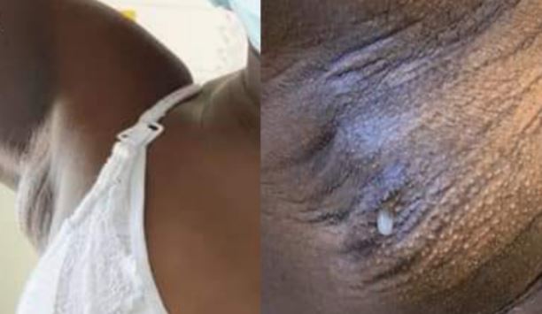 Portuguese woman strangely produces Breast milk out of her armpit