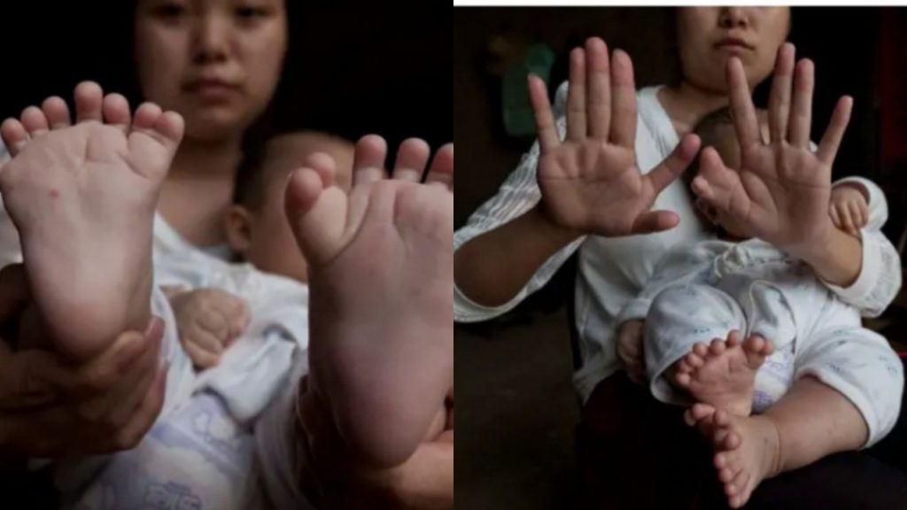 Infant born with extra 16 toes and 15 fingers which has surprised doctors