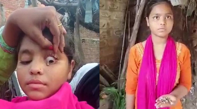 Indian Girl Who Cries Stone Tears Leaves Doctors Baffled
