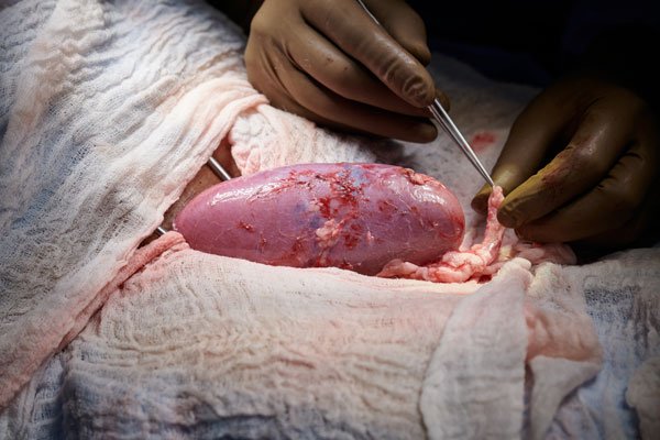 U.S. man recovering after ‘breakthrough’ pig-heart transplant