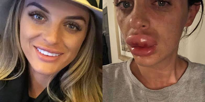 England Bans Lip Filler And Botox Injections For Girls Under 18