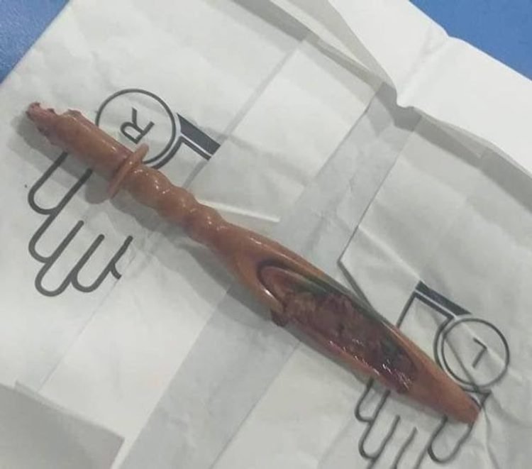 Iraqi Doctors Extract Mysterious “Stick” Fragment From the Coccyx of Paraplegic Woman