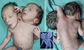 Meet the Baby born with two heads, three arms and two hearts ;Doctors amazed