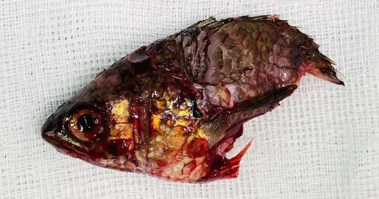 Man Undergoes Surgery After Fish Jumps Out of Water Straight Into His Throat