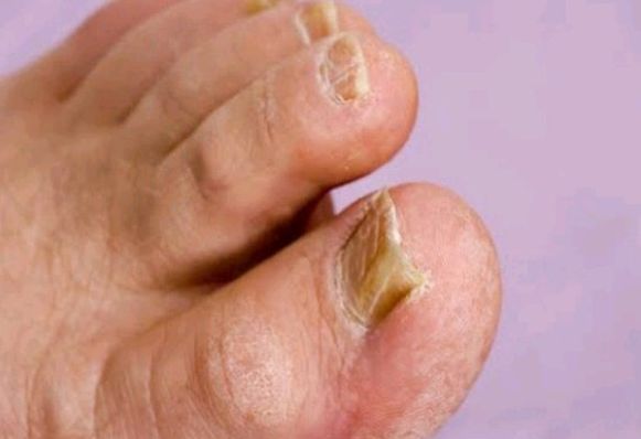 HIV Earliest signs that you should know