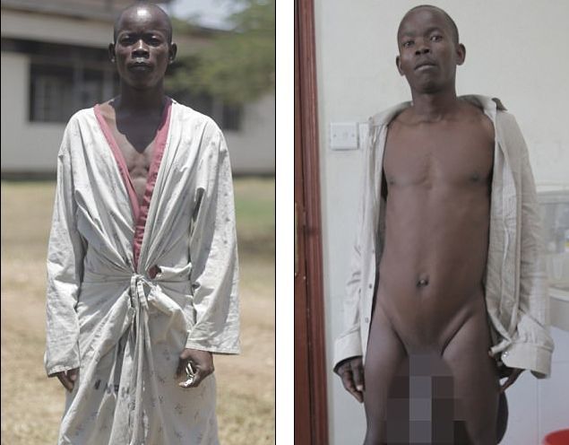 Watch As Kenyan Man with Manhood 10 Times Normal Size To Have Normal Sexual Function After Successful Surgery