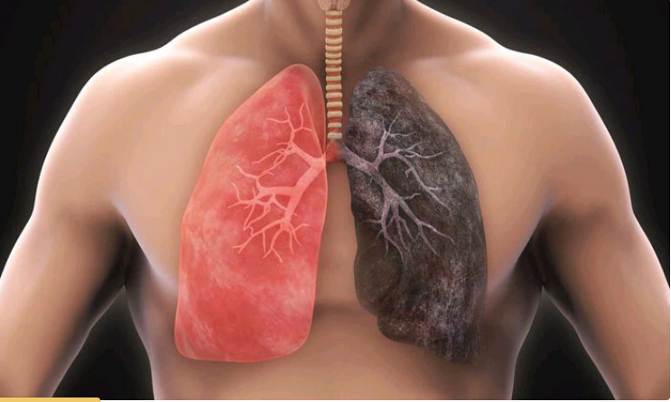 If You Are Engaging In These Four Actions, You Are Gradually Harming Your Lungs
