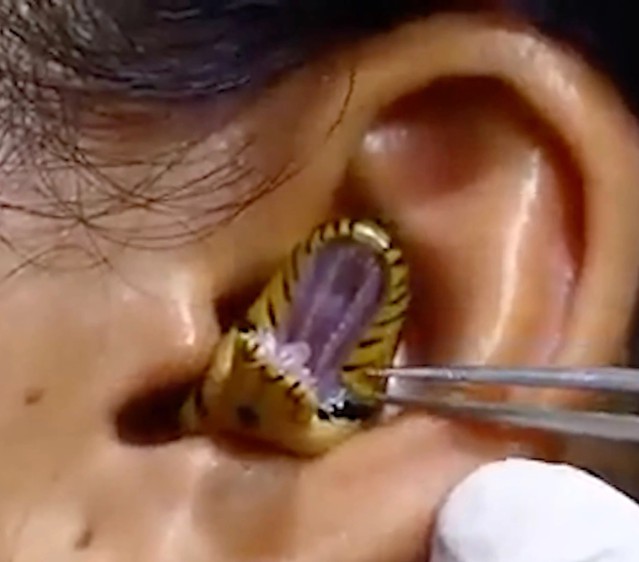 Watch Bizarre As Surgeons Struggle To Remove Live Snake From Woman’s Ear