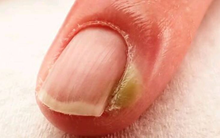Avoid Biting Your Nails If You Don’t Want This To Happen To You