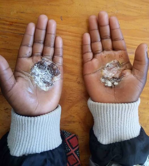 Woman Arrested For Burning Sister In-Law’s Daughter With Hot Spoon Mzimba