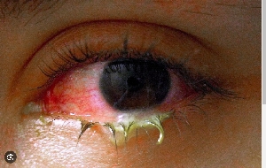 Conjunctivitis Outbreak Hits Karonga Districts