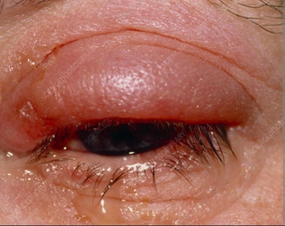 Ntcheu district registers 42 pink eye cases