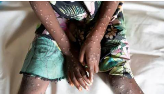 Mpox Outbreak Hits Africa