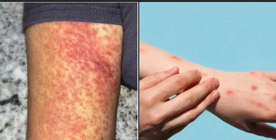 China Reports 7,000 Cases of New Chikungunya Virus