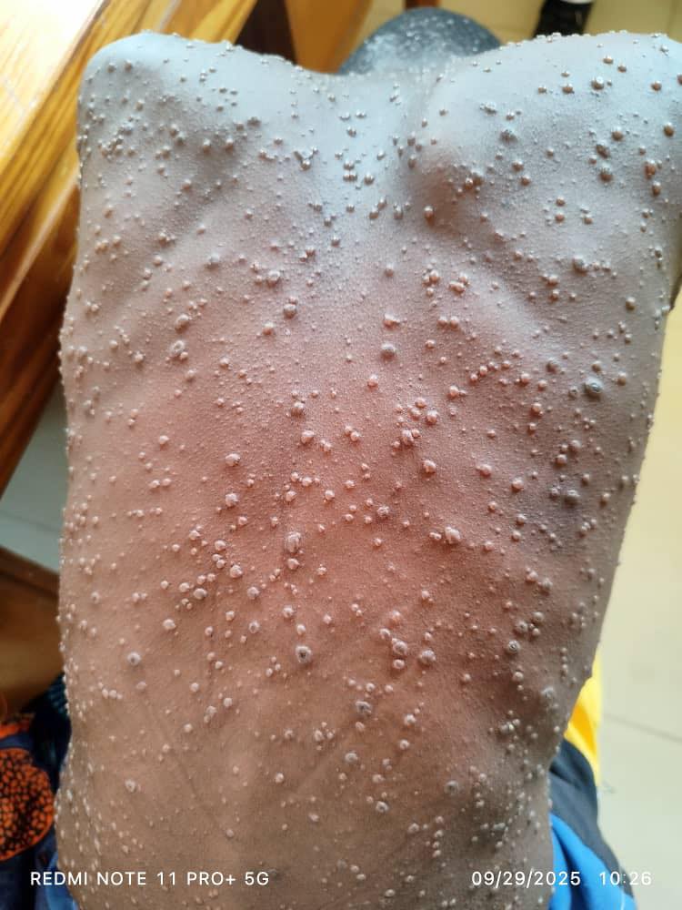 Machinga Records Second Suspected Case of Mpox This Year