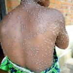 Malawi Registers New Mpox Case, Total Rises to 141 Since April