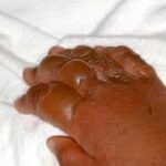 Man burns stepson’s hands over Mkhwani (Pumpkin leaves)