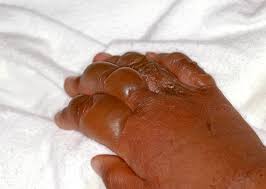 Man burns stepson’s hands over Mkhwani (Pumpkin leaves)