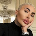 ‘Lip King’ Jordan Parke Dies After Alleged Cosmetic Procedure in UK