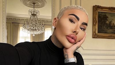 ‘Lip King’ Jordan Parke Dies After Alleged Cosmetic Procedure in UK