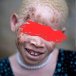 Man Denies Calling Woman with Albinism “Walking Money” Worth K7m, Case Adjourned