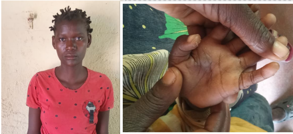 Mother Arrested in Mwanza for Burning Child Over Alleged Theft