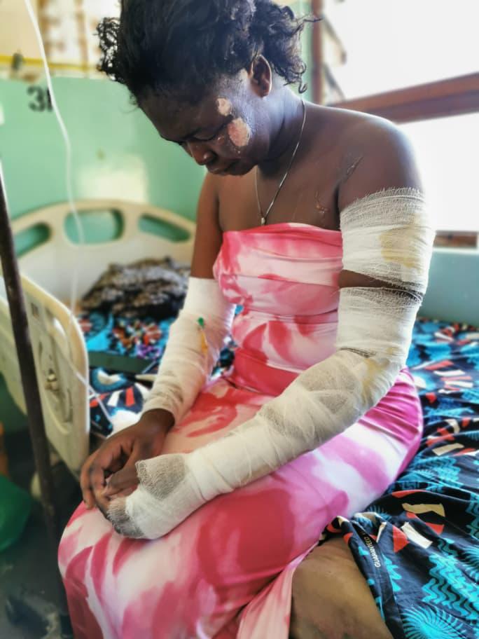 Woman Hospitalised After Gas Cylinder Explosion in Mangochi